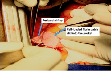 Stem cells progenitor cell-loaded fibrin patch