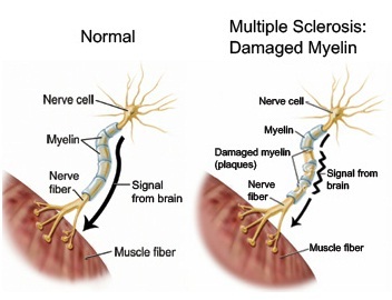 Stemcells multiple sclerosis